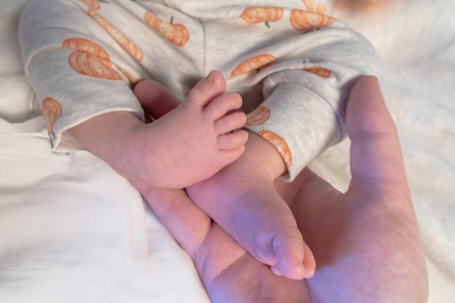 infant with club foot